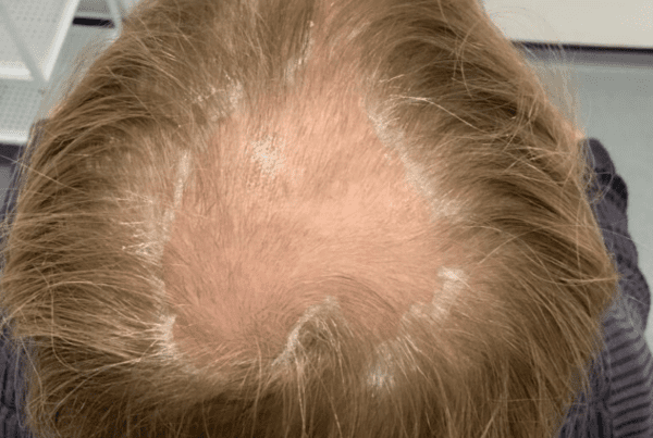types of hair loss - the science