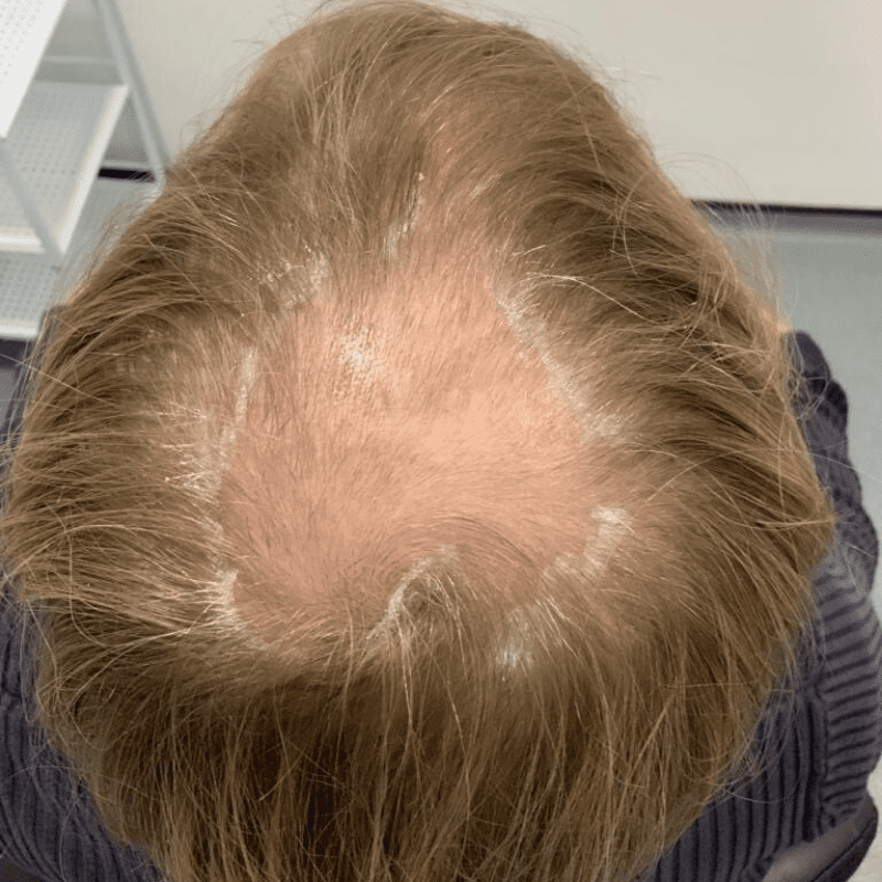 types of hair loss - the science
