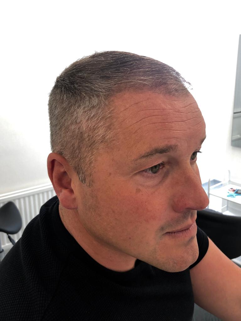 Paul Robinson has Hair Transplant with KSL Clinic in Manchester