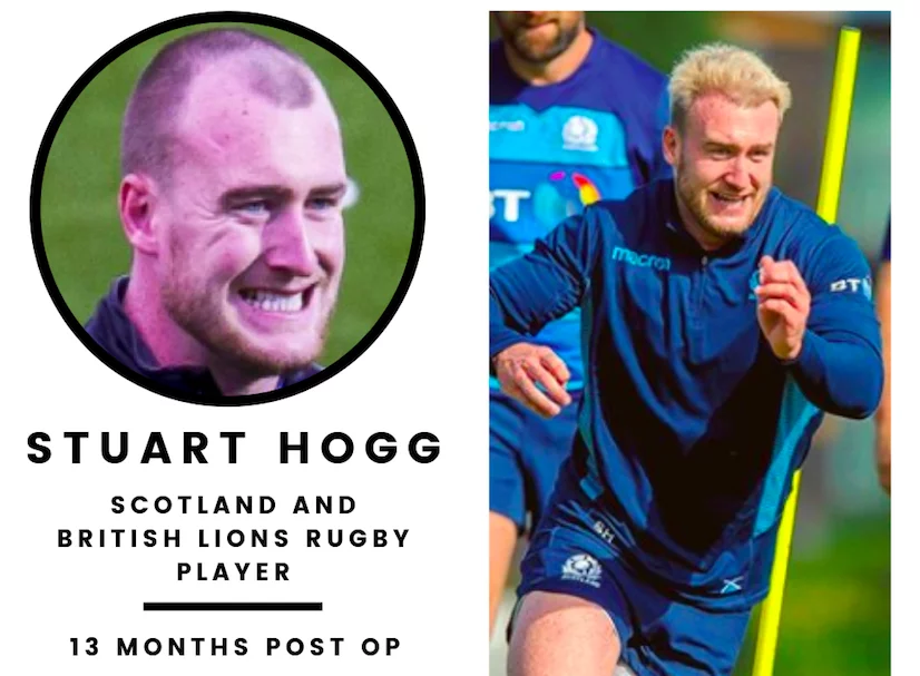 Stuart Hogg 13 months post his hair transplant at the KSL Clinic