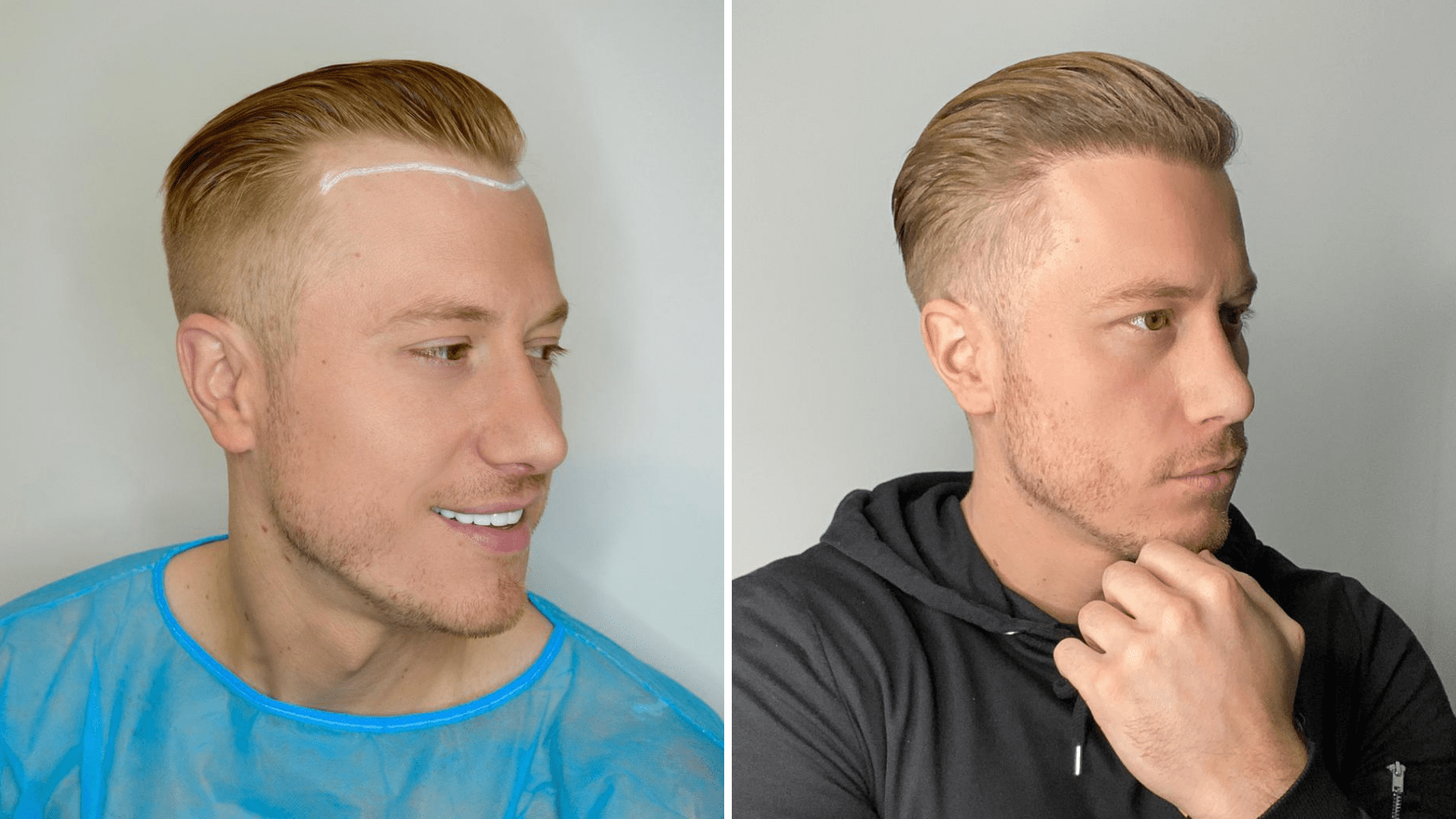 Hair transplant growth stages week by week and month by month [Progress]
