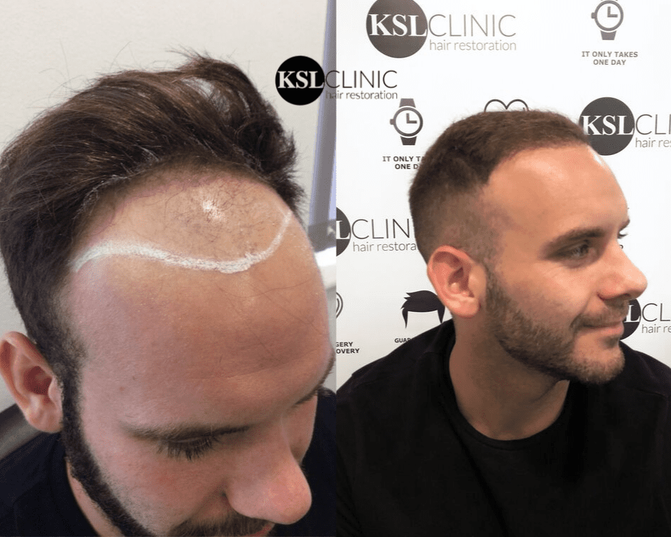 FUE Hair Transplant UK / FUE hair restoration / Costs, what is it, before  and after?