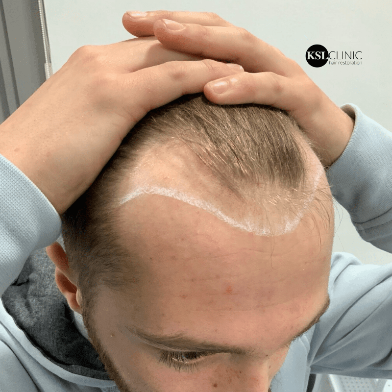 How does hair transplant work / How does hair restoration work? Find out  here
