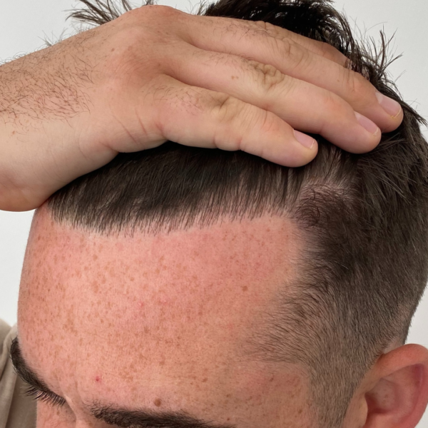 Hair transplant before and after UK picture / Before and after hair  restoration