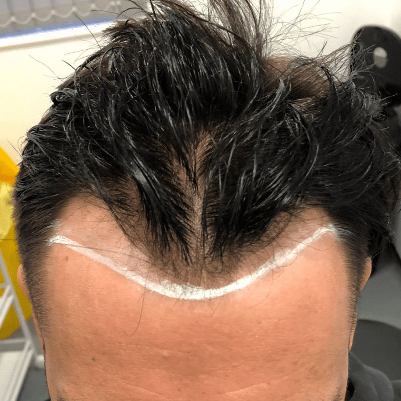 With the football season over, the hair transplant season begins…