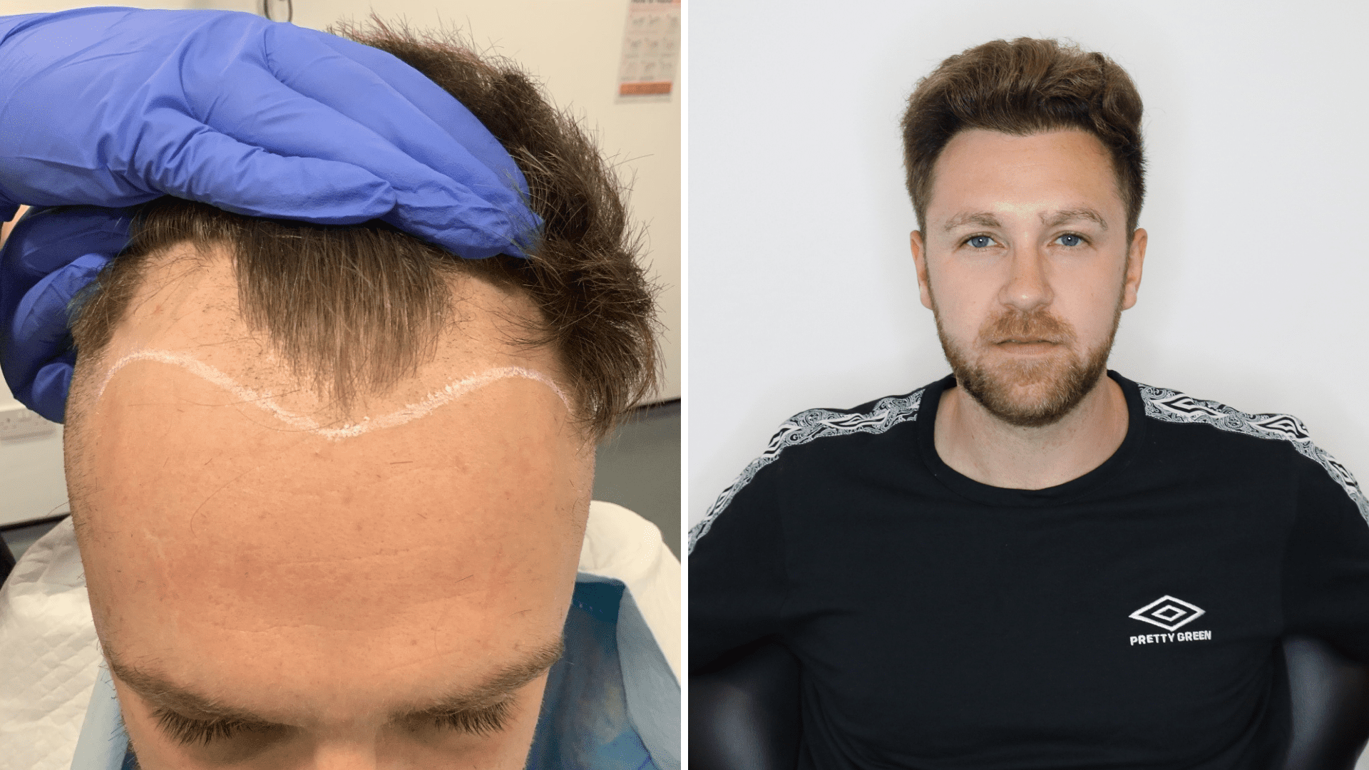Hair Transplant Cardiff / Vist our Hair Loss Clinic Cardiff / Costs & more!