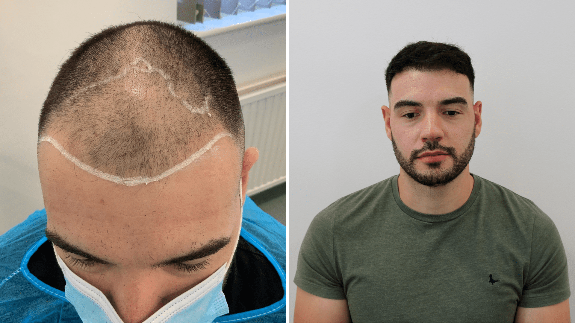 Hair Transplant Manchester / Hair Loss Clinic Manchester / FUE / Cheap?  Costs?