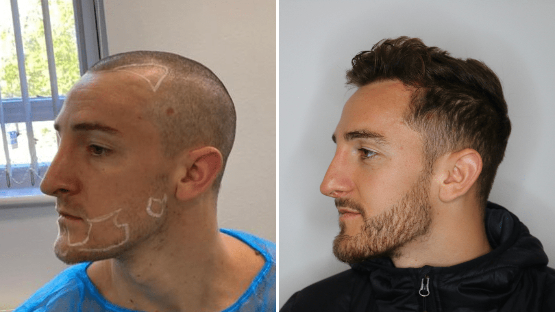 Hair Transplant Essex / Hair Loss Clinic Essex / FUE / Cheap? Costs?