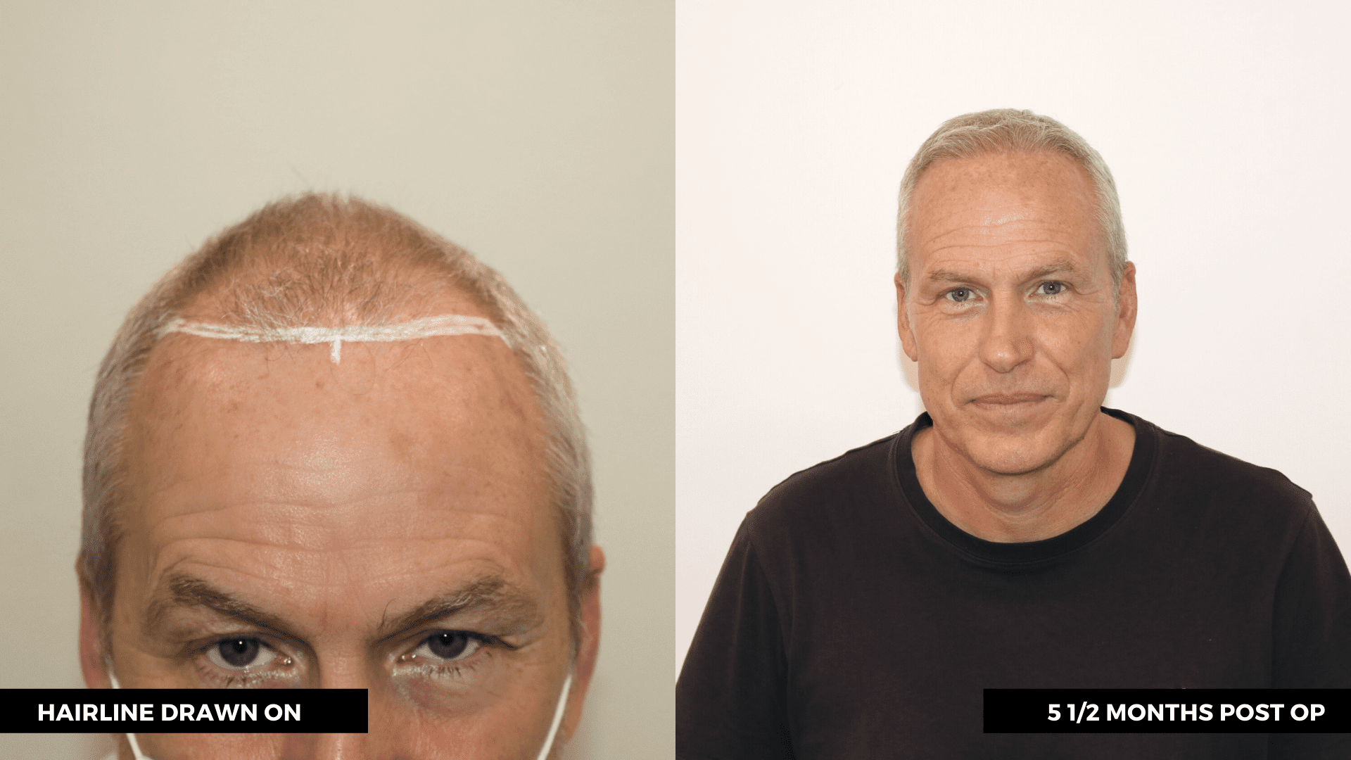 Hair Transplant Turkey | Facts You Should Know | ClinMedica