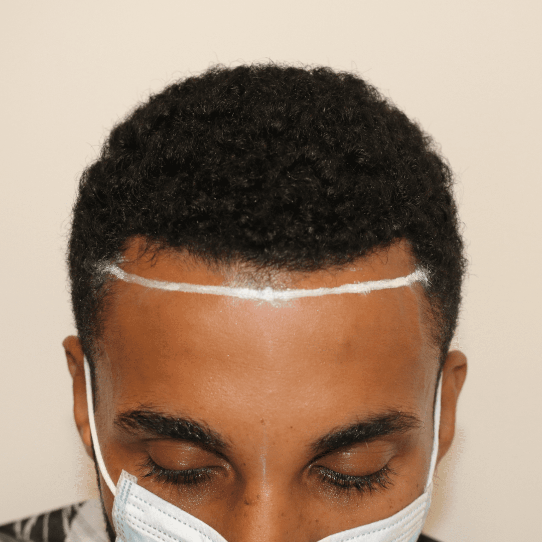 What to Expect 10 Days After Hair Transplant / Find out here