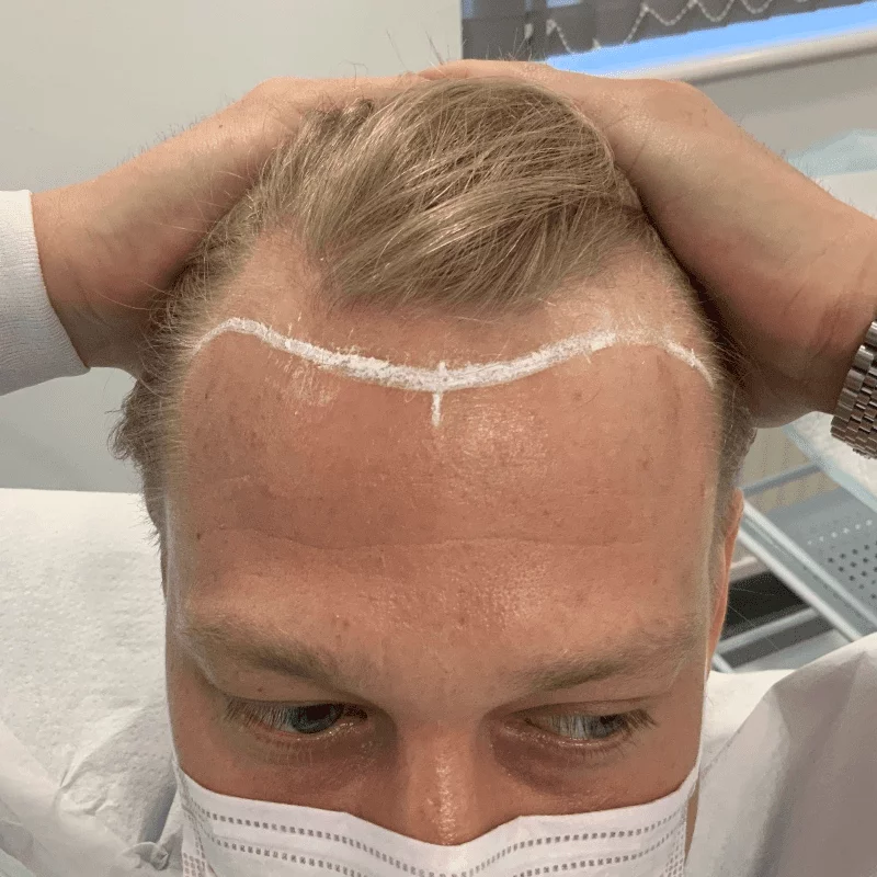 Hair Replacement vs. Hair Transplant: Which is Right for You?