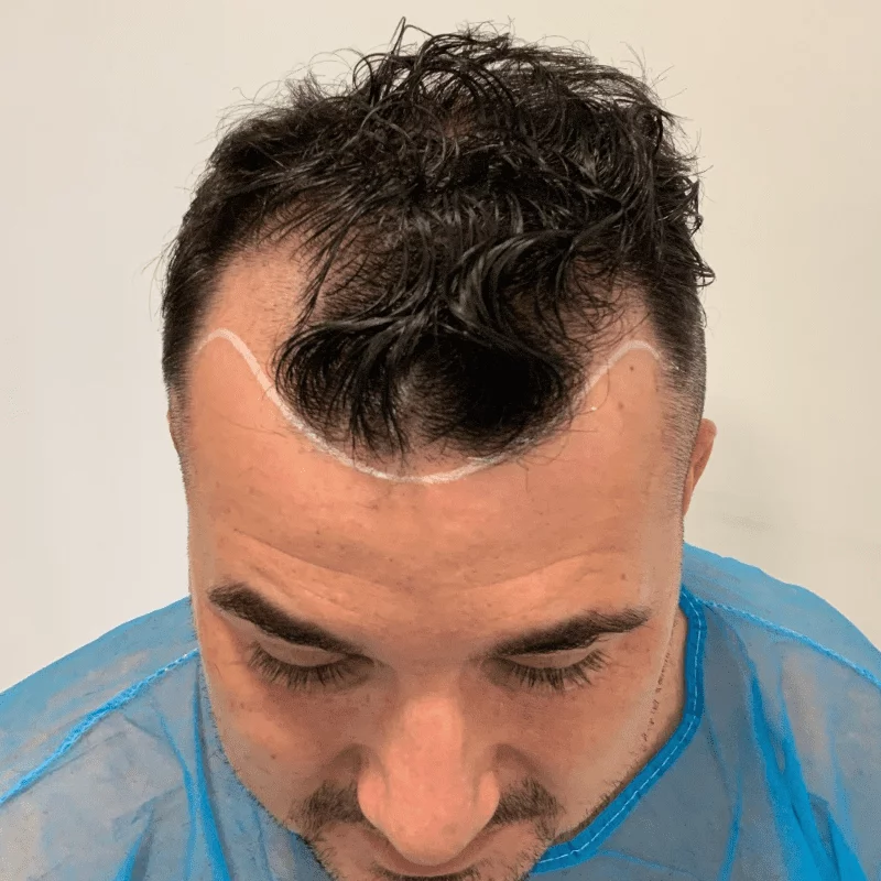 Hair Transplant after 1 Week – what to expect
