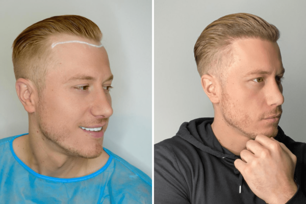 3 month after hair transplant