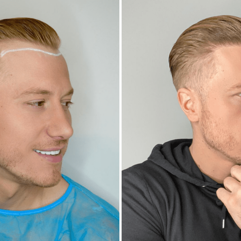 3 month after hair transplant
