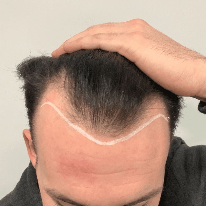 Are You the Perfect Hair Transplant Candidate?