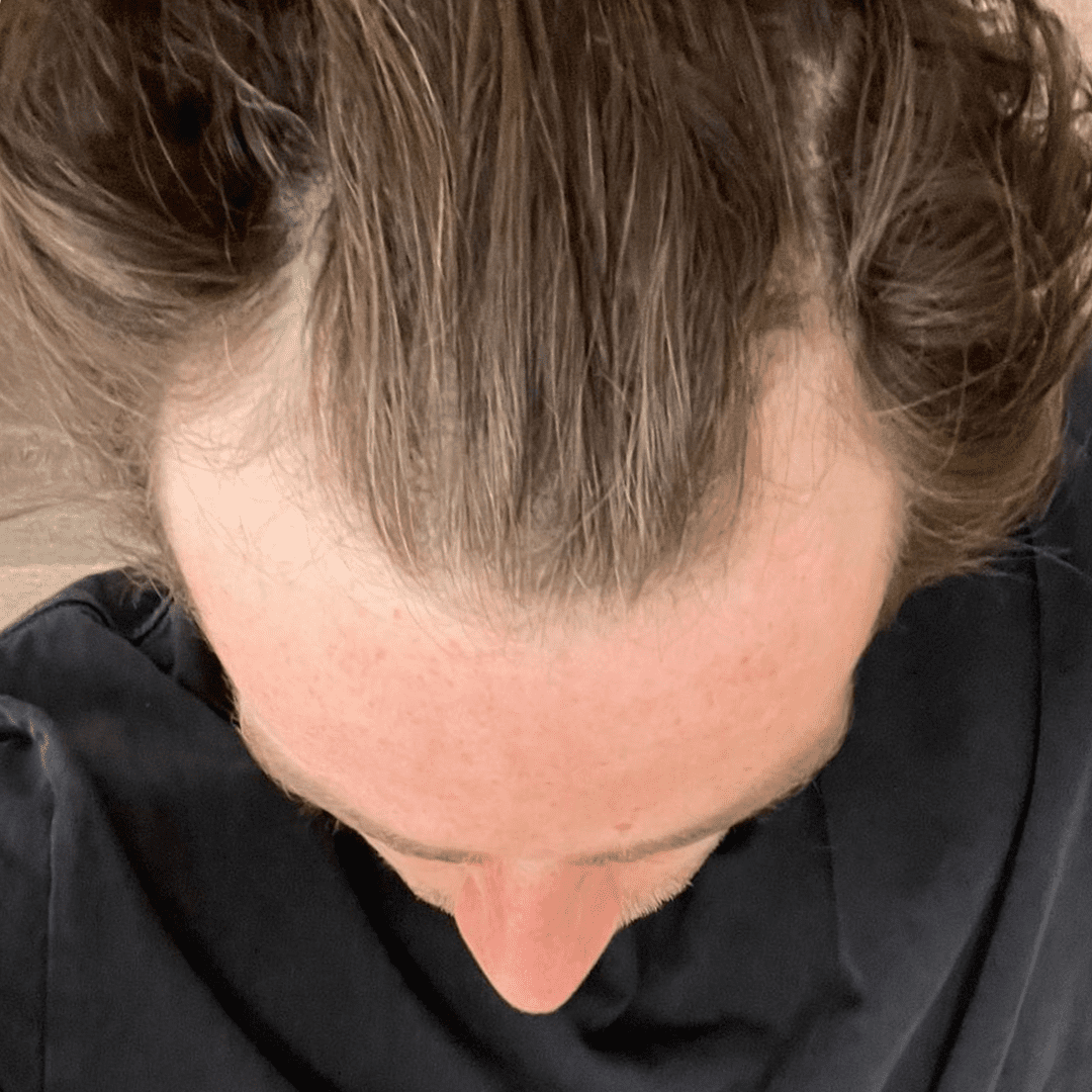 Sleeping after hair transplant – here’s what you need to know