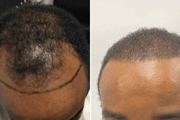 afro hair transplant before and after 1