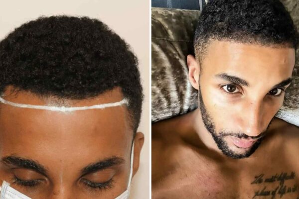 afro hair transplant before and after 3