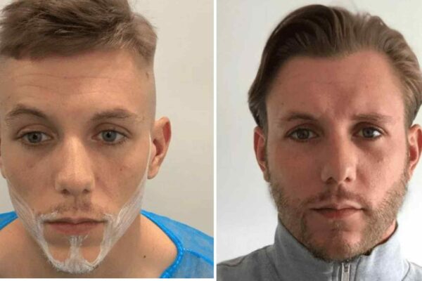 beard hair transplant before and after 1
