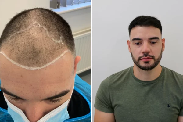 before and after FUE hair transplant