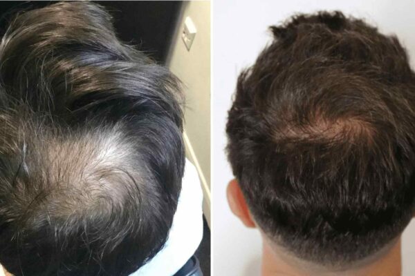 crown hair transplant before and after 1