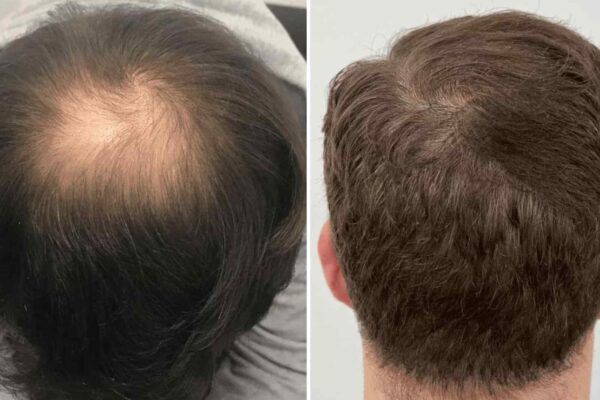 crown hair transplant before and after 2