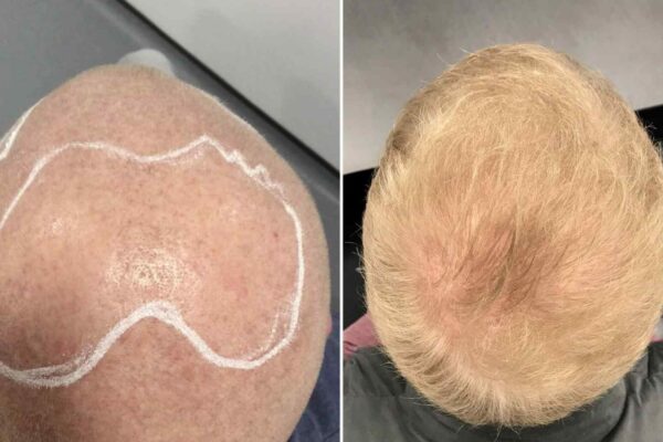 crown hair transplant before and after 5