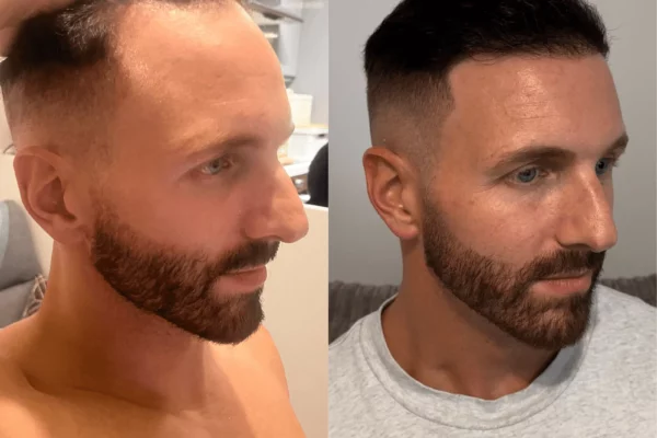patient-2-hair-transplant-before-and-after