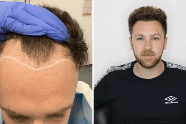 patient 3 - hair transplant - before and after