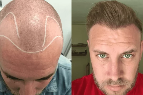 receding hairline transplant before and after