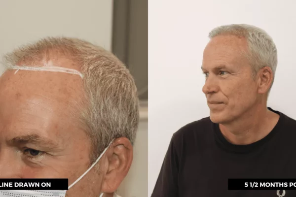 rob wotton - hair transplant before and after