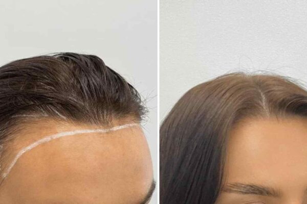 womens hair transplant before and after 1