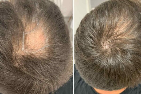 crown hair loss before and aftern