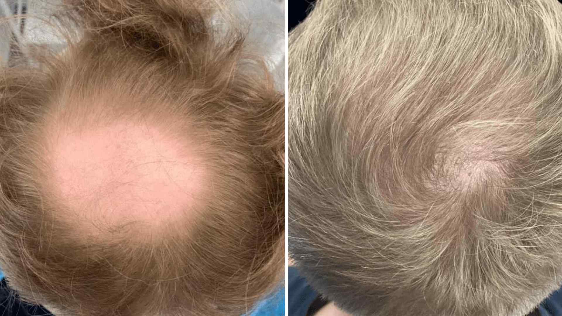 30 Haircuts For Balding Crown To Fix Bald Spots Fast GLJY